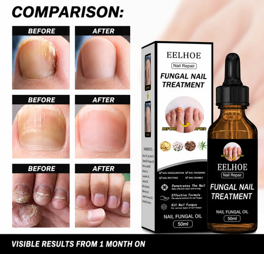 Fungal Nail Care Oil – Nail Repair & Conditioning Treatment, 50 ml