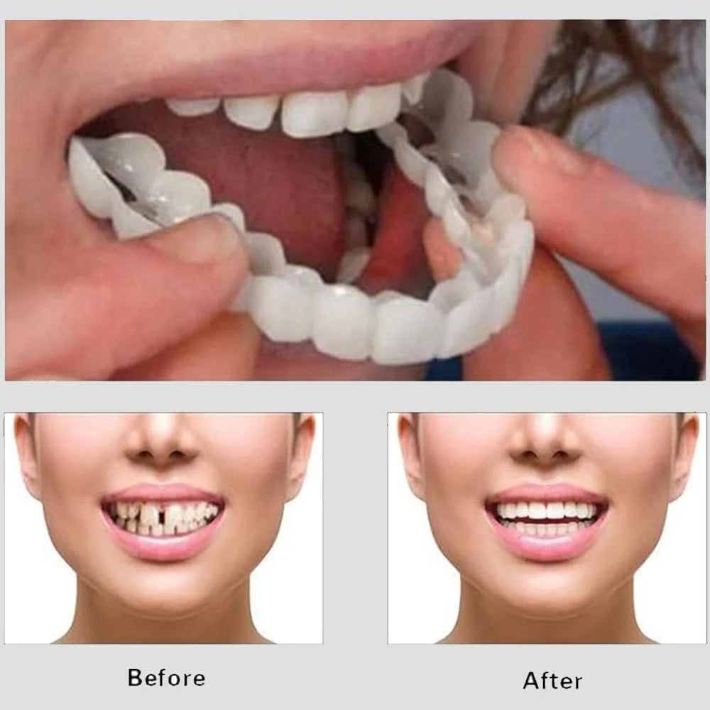 Snap-On Smile Cosmetic Teeth Cover – Removable Smile Enhancer with Storage Case